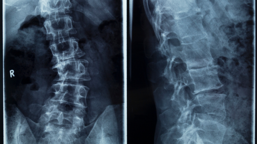 Osteoarthritis and Eases Scoliosis